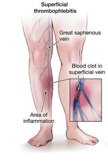 THROMBOPHLEBITIS How is it diagnosed? When is it serious?