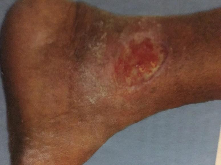 VENOUS ULCERS Always compromised by swelling