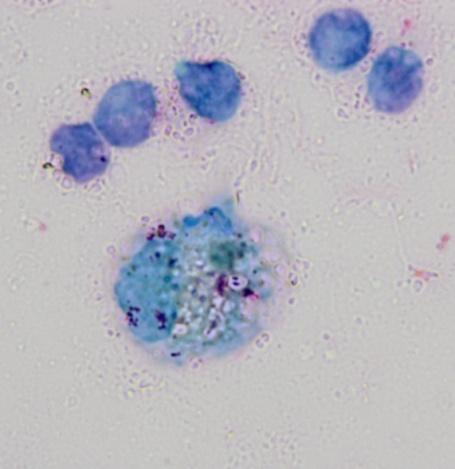 Introduction diagnosis IMPORTANT: Check travel history to endemic area Mycological test(yeast cells phagocyted by monocyte or