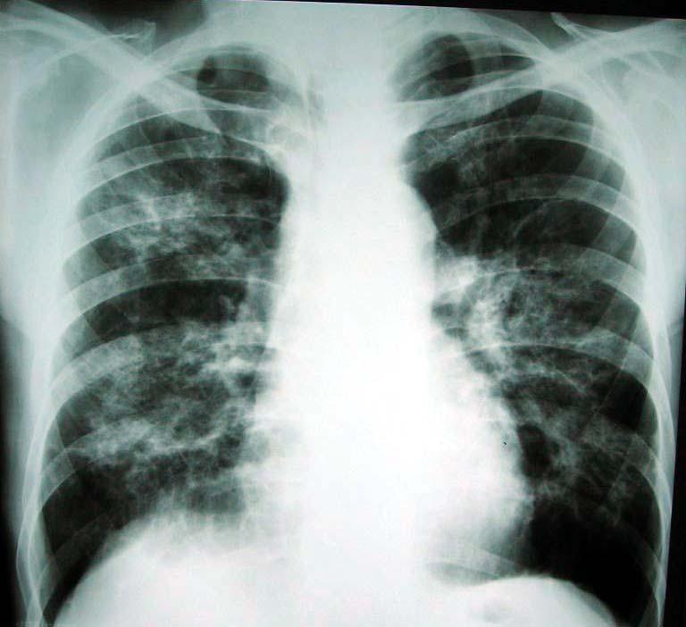 Chest radiograph and CT scan of a middle- age smoking male with chronic pulmonary histoplasmosis showing bilateral cavitary infiltrates.
