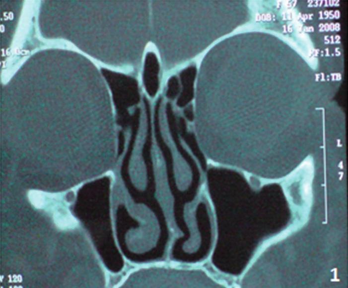 Figure 1. Preoperative coronal section CT scan showing crista galli pneumatization with mucosal thickening. Figure 2.