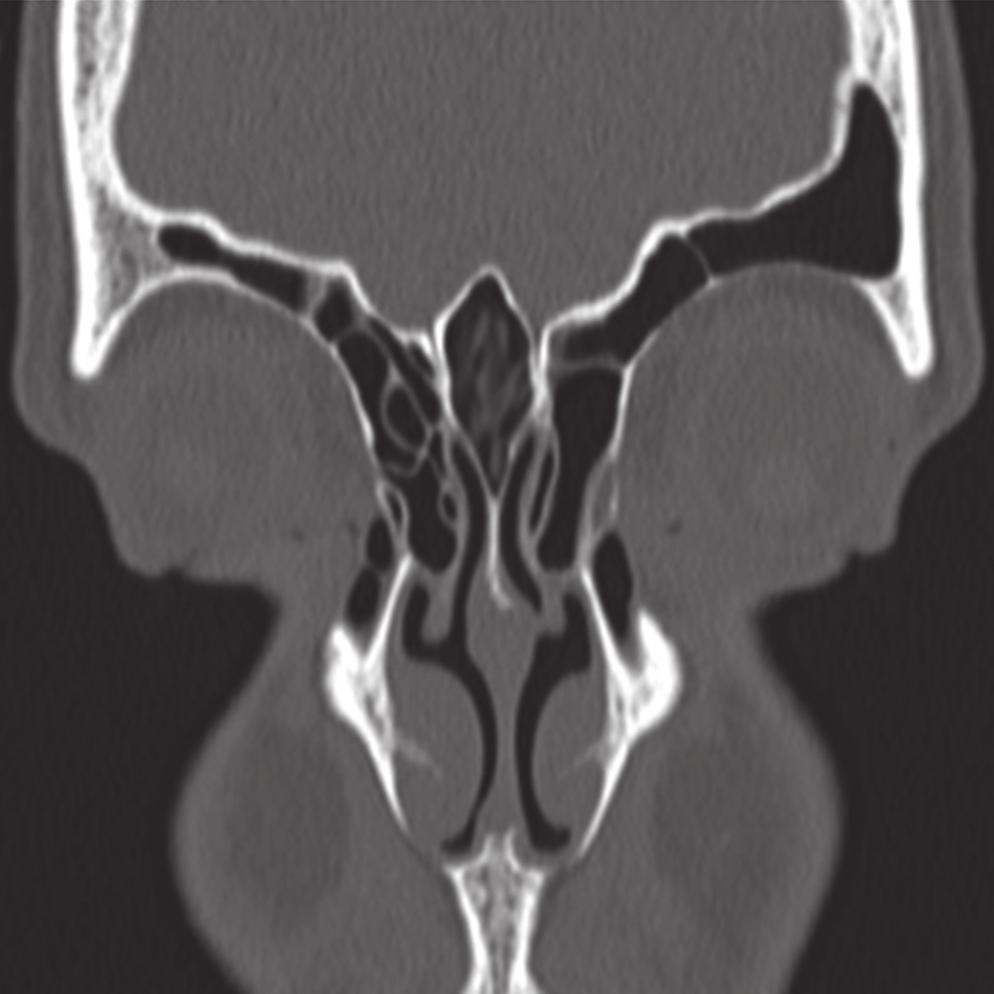SEPTO = nasal septum; CM = middle turbinate; CI = inferior turbinate. and clavulanate potassium for 10 days. However, she always experienced recurrence and progressive worsening of her symptoms.