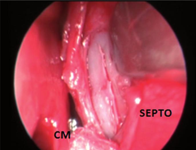 Figure 4. Intraoperative endoscopic visualization of the right nasal cavity showing septal incision and detachment. Figure 5.