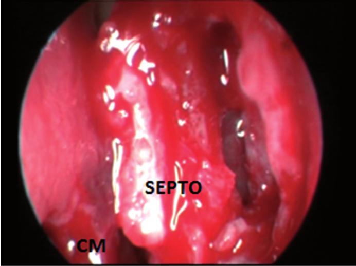 Intraoperative endoscopic visualization of the right nasal cavity showing transseptal opening of the bone wall of the pneumatized crista galli. Figure 7.