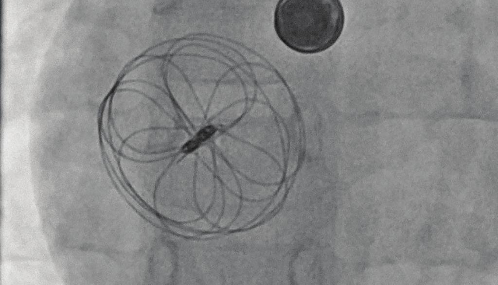 A fluoroscopic (x-ray) image is used to see the metallic frame of the ASD closure device, and an ultrasound image allows the doctor to see the heart structures and blood flow.