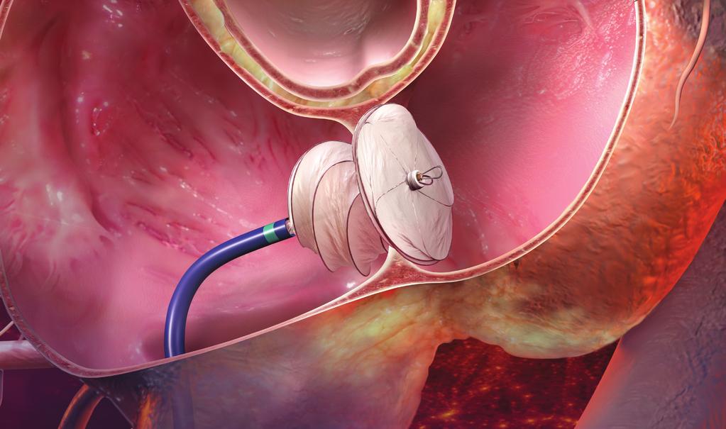How does the GORE CARDIOFORM Septal Occluder work?