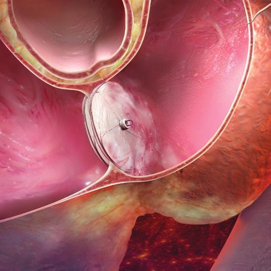 inside the heart, the eptfe material-covered wire frame of the GORE CARDIOFORM Septal Occluder is deployed to form the device on either side of the defect between