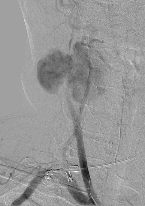 266 Chiriac et al Extracranial internal carotid artery aneurysm by a combined approach, endovascular carotid occlusion and surgical aneurysm resection.