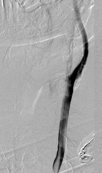The procedure showed a good arterial compensation of the right internal carotid artery territory by left internal carotid injection via anterior communicating