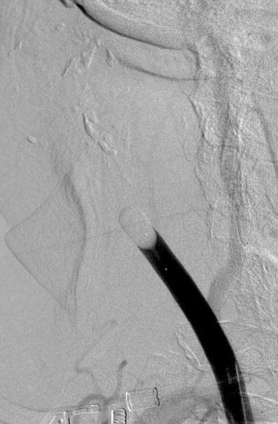 The right vertebral artery injection with right carotid temporary balloon occlusion showed a partial posterior communicating artery contrast filling (Figure 4).