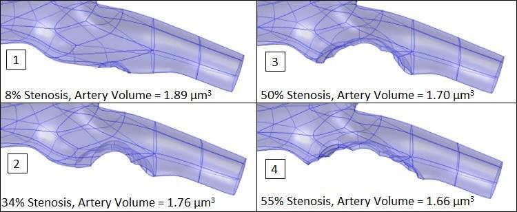 Figure 6: The end result of particle tracing simulations showing the locations of stuck particles in orange along the edge of the plaque. Figure 7: Four select stages of plaque growth.