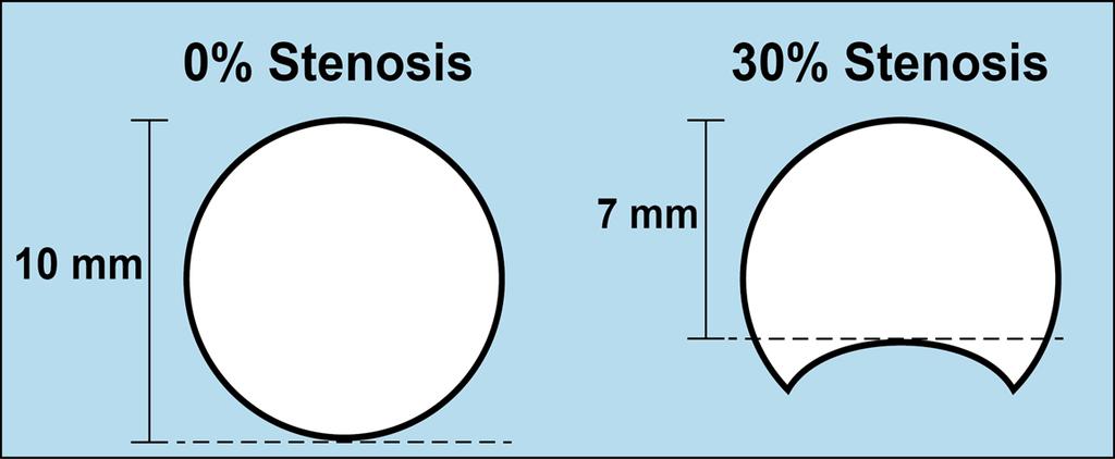 Figure A3: Percent stenosis is defined as the reduction of diameter of the artery. Figure A4: Relationship between aspirin concentration and fractal dimension, which corresponds to blood viscosity.