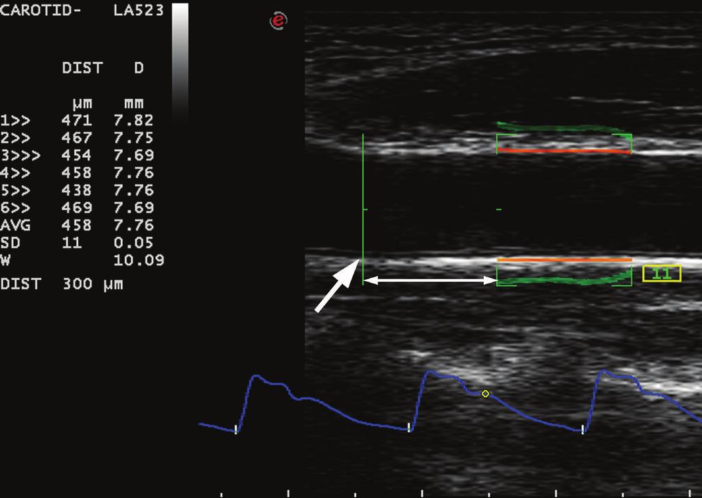 (b) Longitudinal grey scale sonogram showing the measurement of the arterial stiffness of the same CCA using radiofrequency-based quality arterial stiffness.
