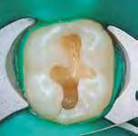 Since G-ænial Bond doesn t require etching and its self-etching approach offers a high adhesion to dentine, the dentinal
