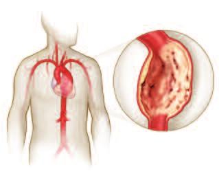 What Is an Aneurysm? What Is an Aneurysm? An aneurysm is a bulging or ballooning of a weakened area of a blood vessel. Aneurysms usually result when proteins that make the artery elastic break down.