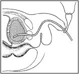 9.1 Urinary Bladder & Urinary Retention Uretheral Catheterization in the male patient If you fail to pass a catheter, proceed to filiforms and followers or use a Foley catheter with a guide.