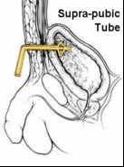 introduction of a catheter into the bladder through the