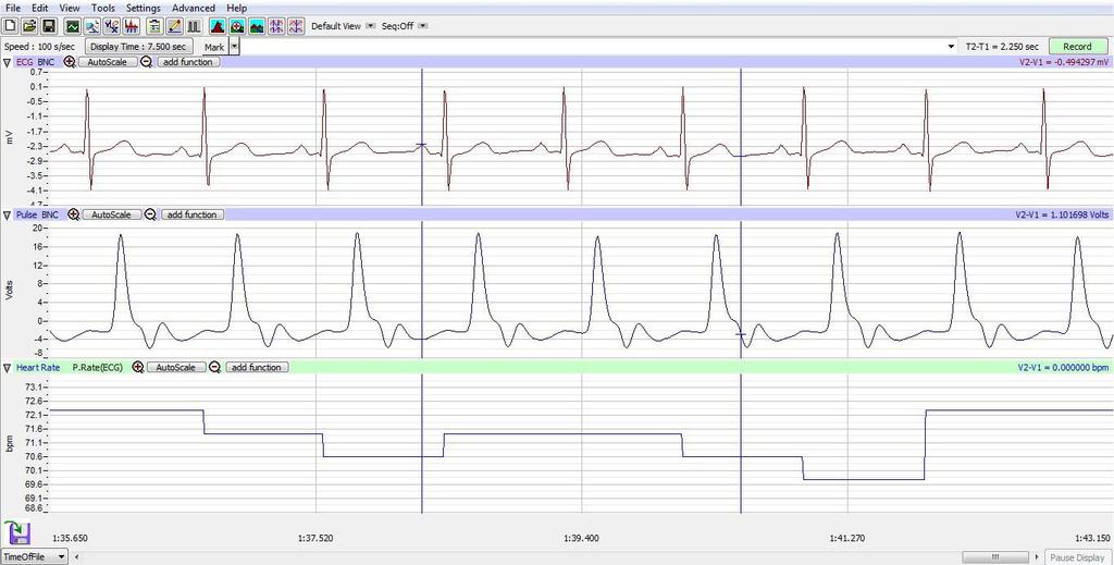 Figure HH-3-L1: ECG, pulse and heart rate displayed on the Main window.