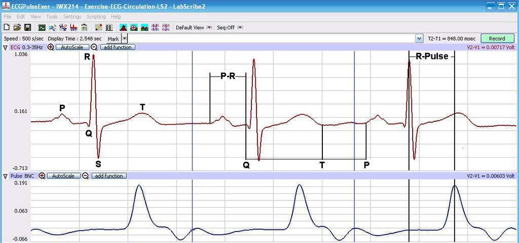 Transfer the values for the amplitudes and beat period to the Journal using the Add Ch. Data to Journal function in the ECG Channel pull-down menu. 7.