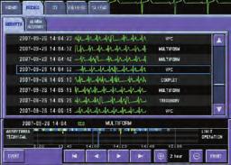 Full disclosure waveforms Arrhythmia recall Up to 72 hours of 5 selected waveforms.