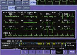 12-lead ECG analysis Multi-lead ST segment monitoring provides you with continuous oversight of