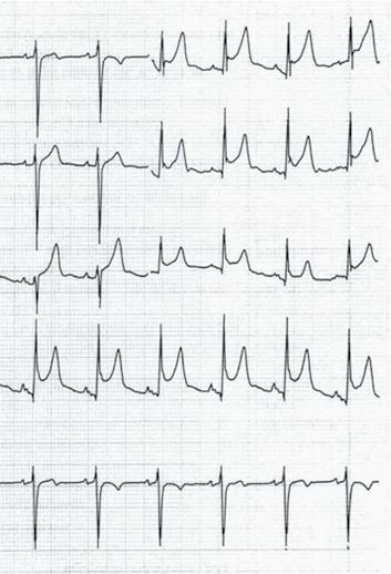 There is also PR-segment depression, which is most evident in lead II. tion myocardial infarction more difficult; in some cases, PR-segment depression is the only ECG finding.