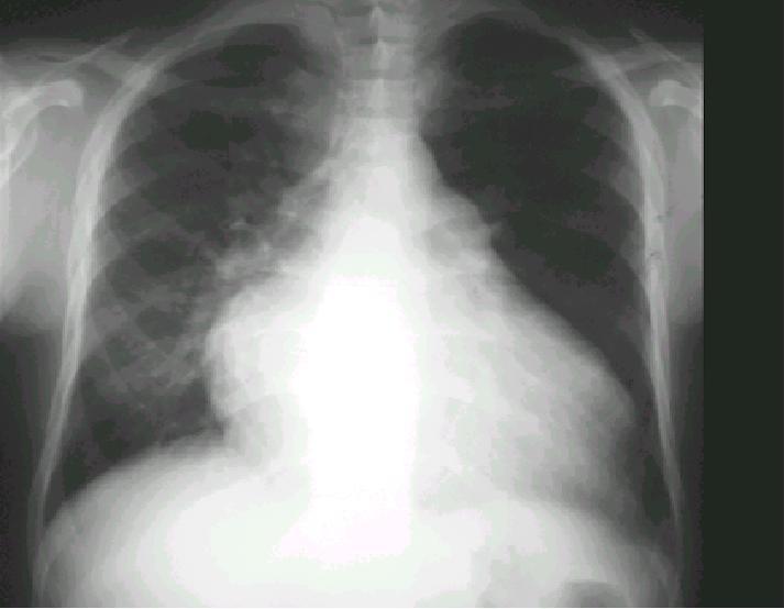 Chest X - Ray Enlarged