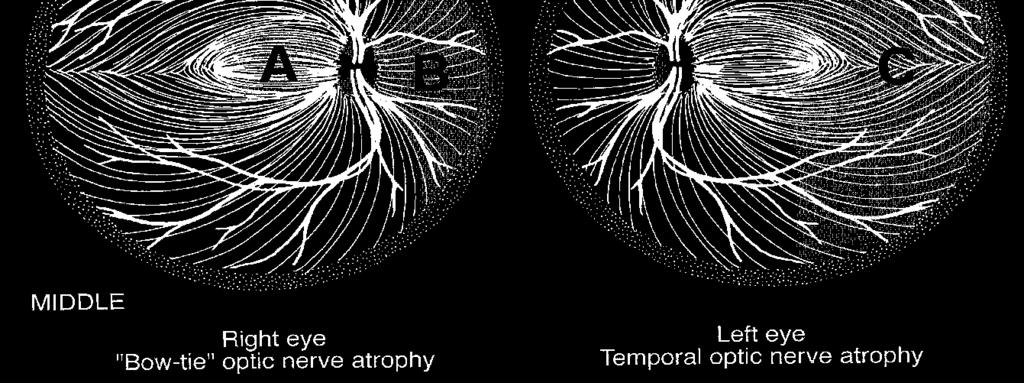 Palloring Associated Optic Nerve Findings Peripapillary hemorrhages: superficial (acquired) vs subretinal (congenital) Crowded fellow optic nerve
