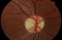 (neuroretinitis) Choroidal folds (hypotony, orbital tumor) Retinal hemorrhages (CRVO) Retinitis, white dots, retinal scars (infection, inflammation)