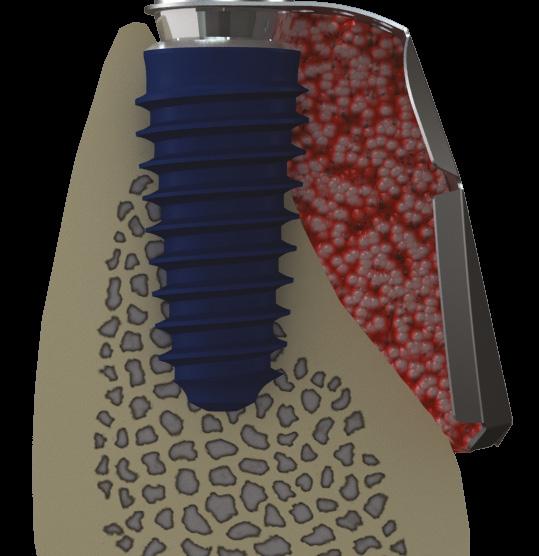 Choose a i-gen cover Screw or Flat Healing Abutment to fix i-gen membrane depend on the need of one or two stage surgery. And tight adaptation of soft tissue flap is recommended.