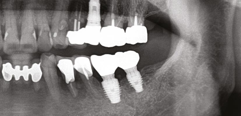 A Healing Abutment was connected