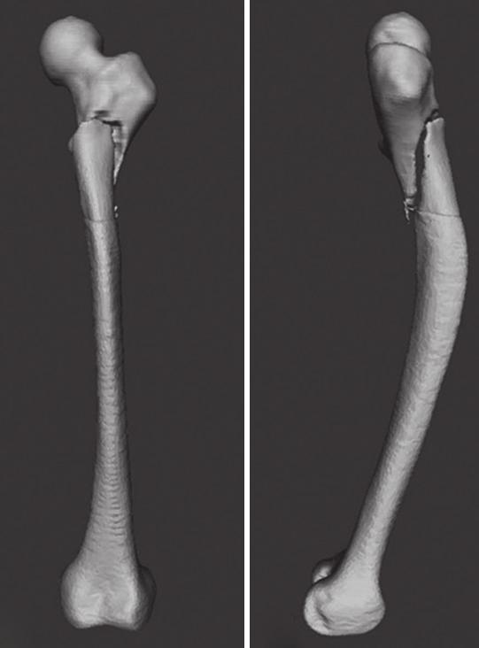 Figure 3: The lignment of the femur is presented y three dimensionl reconstructions with () nteroposterior nd () lterl views of the frctured left femur fter simulted reduction.