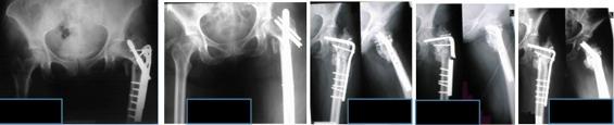 In the image on the right, details of the ICUC App case ID: 31-PE-682 (Reference 4). Fig. 15: Implant fatigue after third unsuccessful surgery.
