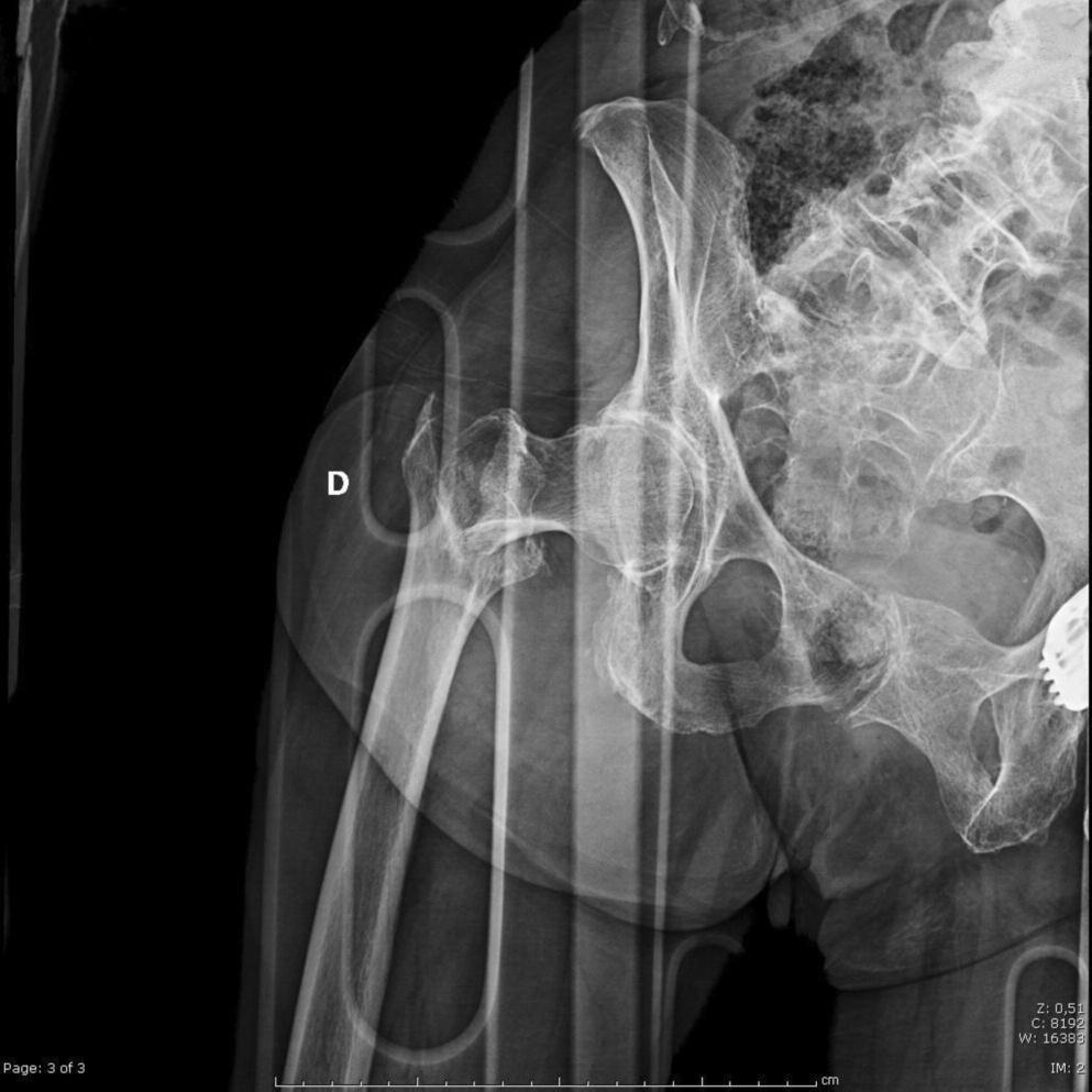 S. Giannotti et al. Figure 2a - Pre-operative X-ray of a lateral femoral fracture in 81- year-old woman. Figure 2b - Post operative X-ray.