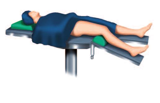 Patient positioning The patient is positioned supine on a radiolucent operating table. Alternatively, the patient may be placed in a lateral position or positioned on an extension table.
