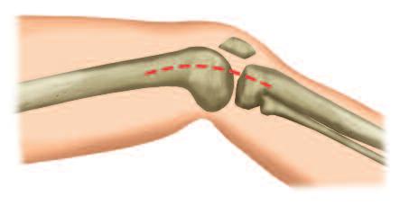 In the distal femur, an open (OA) or minimally invasive (MIS) approach may be used. (OA) For open surgery, the incision is determined by the fracture site and the length of the plate.