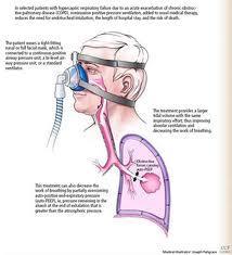 NON INVASIVE POSITIVE PRESSURE VENTILATION During NIPPV, air enters the nose, mouth or