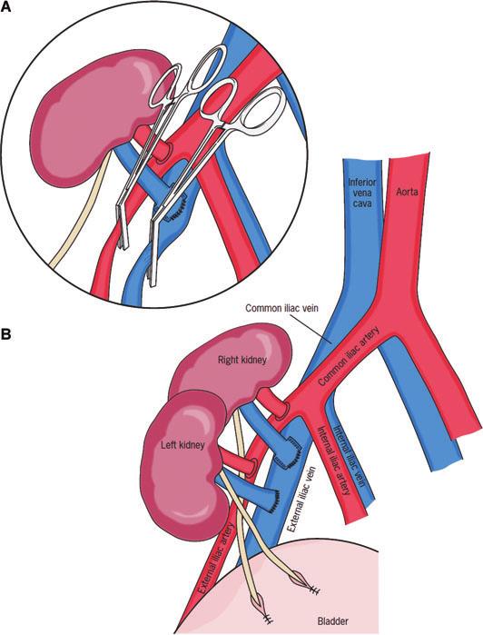 Ekseretal. Figure 2: Surgical technique of unilaterally positioned dual kidney transplantation into the same iliac fossa.
