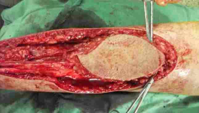 Versatility of Reverse Sural Artery Flap