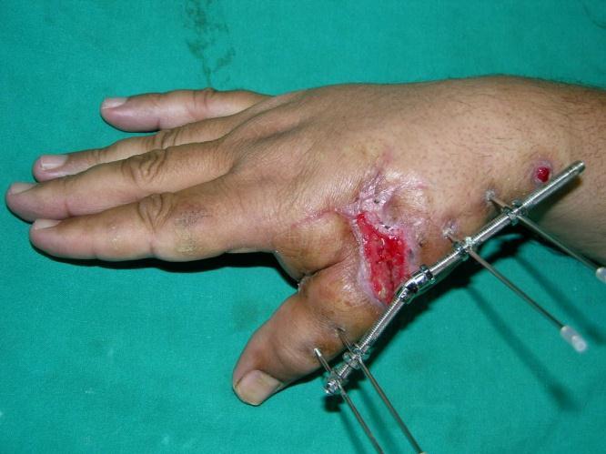 Fig 6: bullet injury to the dorsum of the hand causing open comminuted fracture of the
