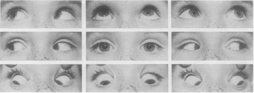 468 Ronald F. Lowe Her twin sister, Jennifer, was examined at this time (Fig. ia). Her eyes appeared parallel and she converged evenly, but the cover test revealed a variable amount of esotropia.