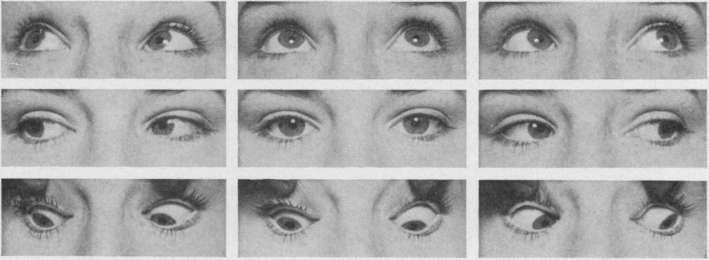 symptoms. She had no head tilt (Fig. IC) and eye movements appeared to be full (Fig. 6). Although she found difficulty in looking upwards there was no divergence on elevation and inferior *:.