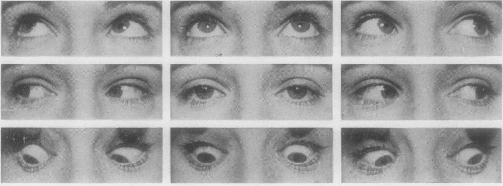 470 FIG. 7 XJennifer, aged i82 years. Normal eye movements in all positions (as in Fig. 3)... Ronald F. Lowe Dr.