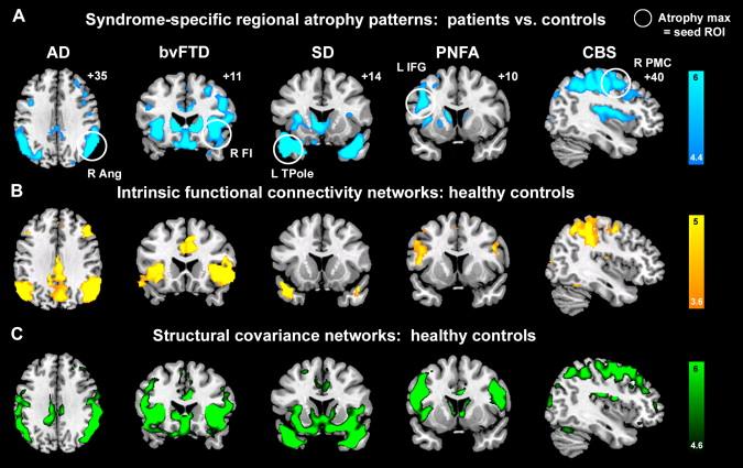 Neurodegenerative Diseases Target Specific Brain Networks Disrupt