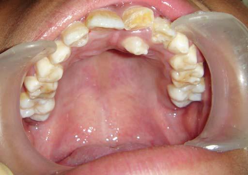 Impacted Supernumerary Teeth Early or Delayed Intervention: Decision Making Dilemma? Fig. 1: Intraoral photograph showing palatally erupted Fig.