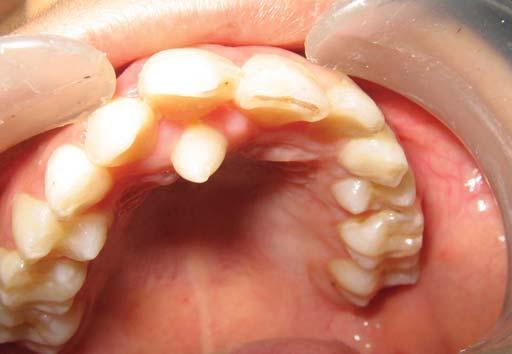 Seema Gupta, Nikhil Marwah Fig. 5: Intraoral photograph showing palatally erupted supernumerary tooth (case II) Fig. 8: Empty socket after removal of impacted supernumerary tooth (case II) 228 Fig.