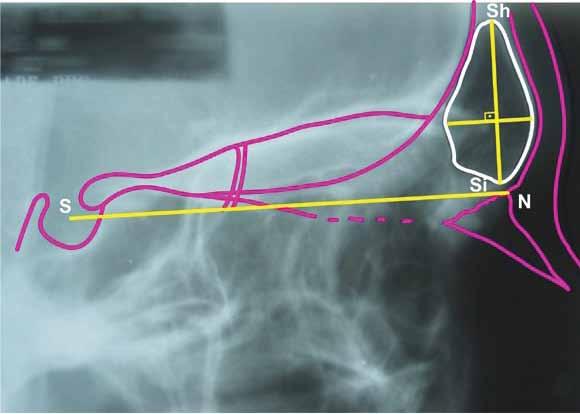 Relationship between mandibular growth and skeletal maturation in young melanodermic Brazilian women Sh S Si N figure 2 - Identification and demarcation of cephalometric landmarks, lines and frontal