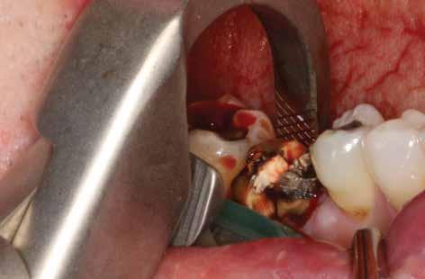 The tooth had received prior endodontic treatment and displayed infection and severe recurrent decay.