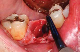 Although the tooth was removed in a manner that minimized trauma to the extraction socket, a large facial defect was present,