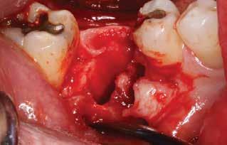 Figure 6: Because there was some crestal bone loss due to the infection of the tooth, a simple envelope